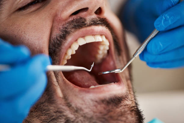 Best Emergency Tooth Extraction in Flat Rock, MI
